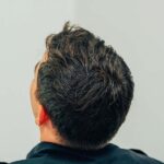 Turkeyana Clinic Hair Transplant